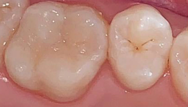 dental cavity after 2