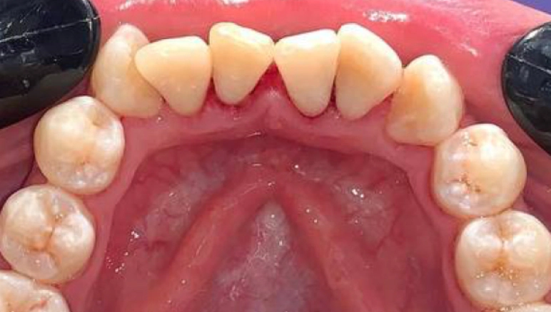 dental plaque after 1