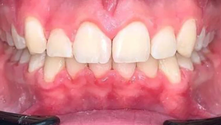 teeth straightening after 2