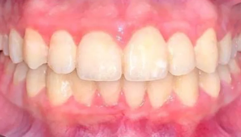 teeth straightening after 3
