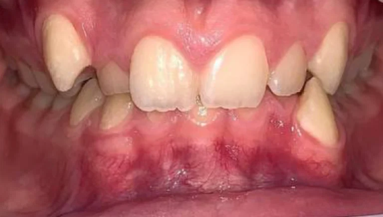 teeth straightening before 2