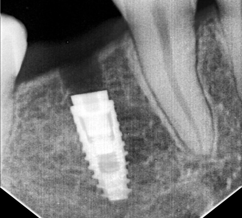 tooth implant before