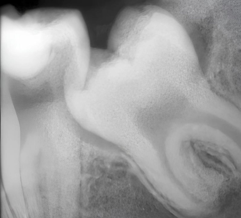 tooth removal after