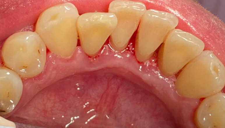 buchynska dental plaque after