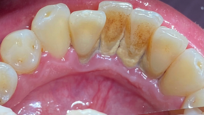 buchynska dental plaque before