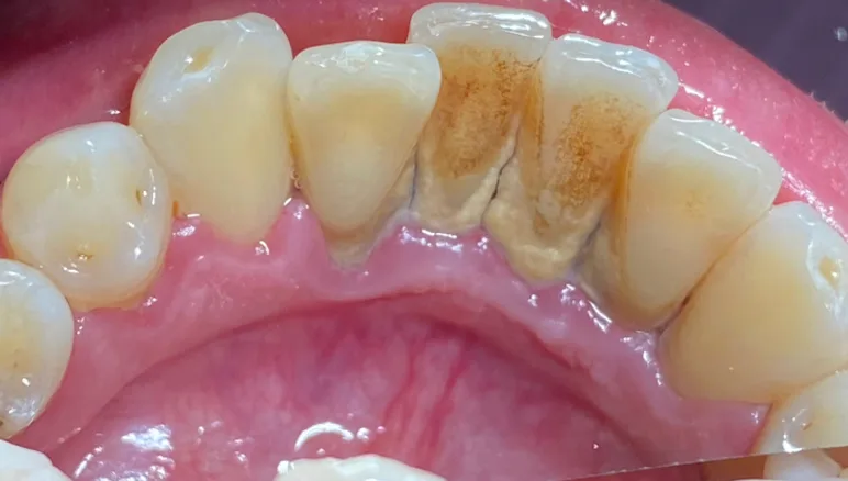 buchynska dental plaque before