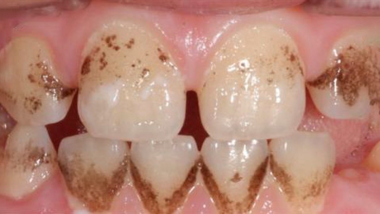 children teeth decay before 2