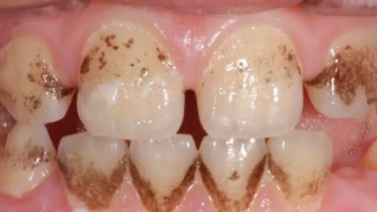 children teeth decay before 2