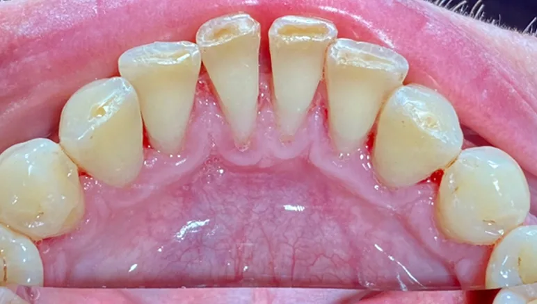 dental calculus after