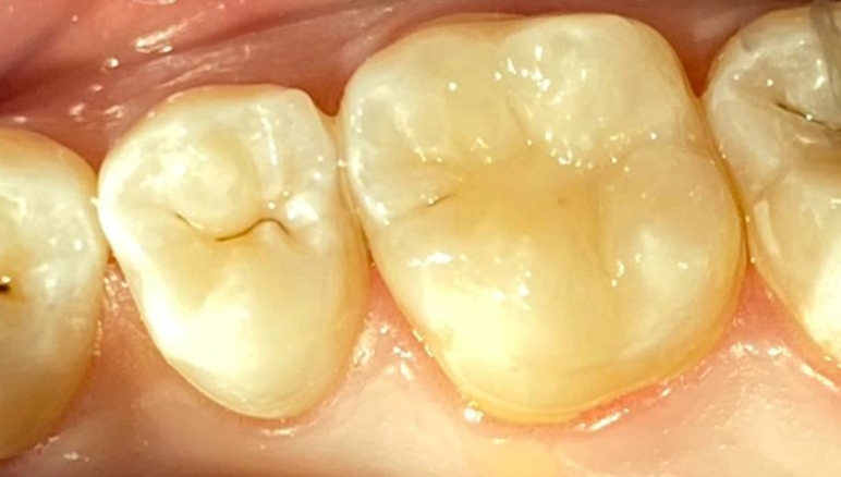 dental cavity after 1