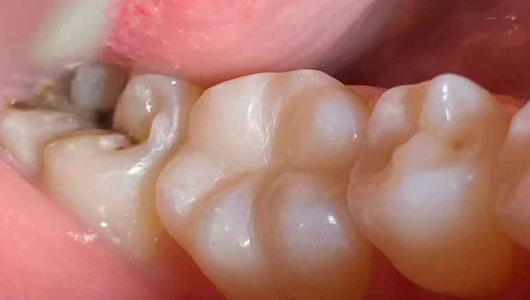 dental cavity after