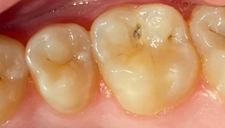 dental cavity before 1