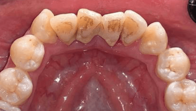 dental plaque before