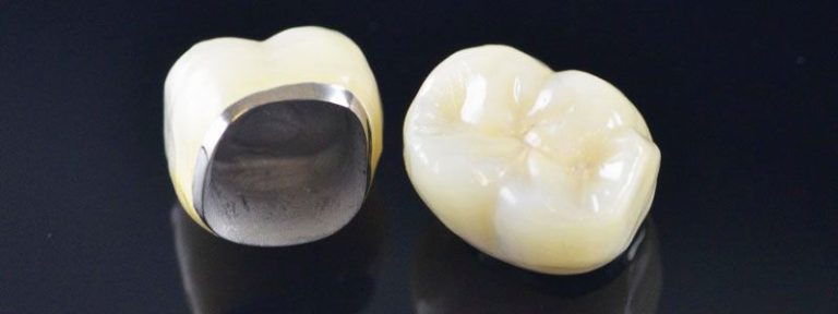 metal ceramic