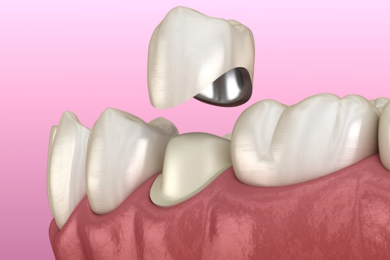 dental crown