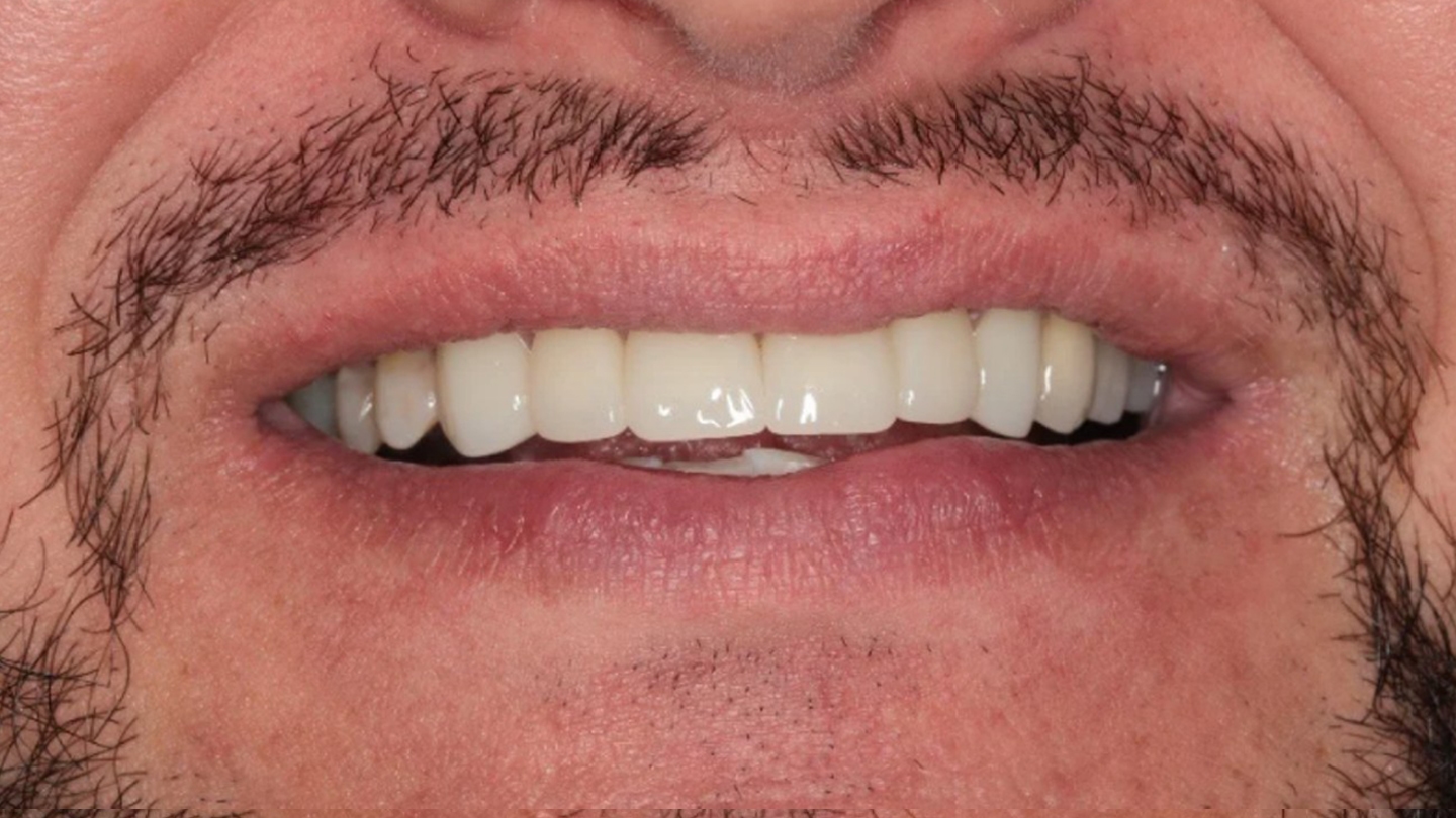 dental crown after 1