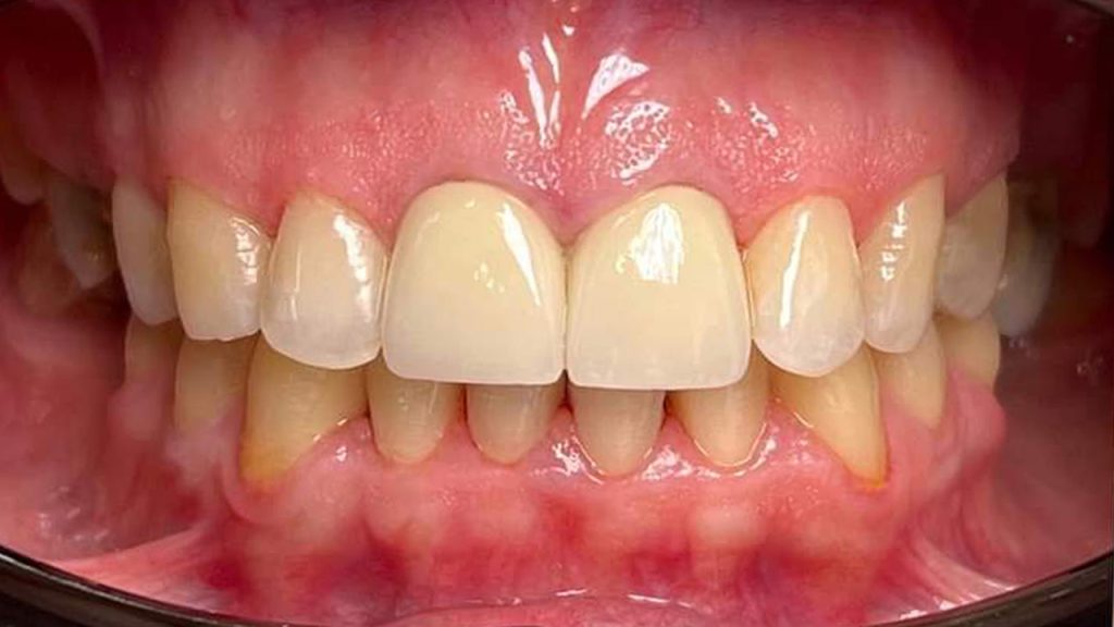 dental crown after