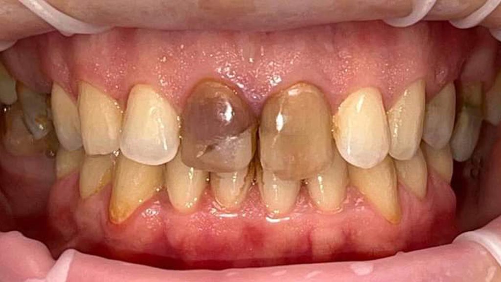 dental crown before