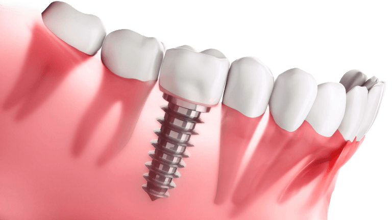 dental implants