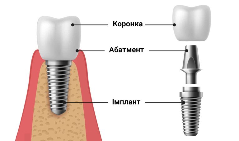 implant structure
