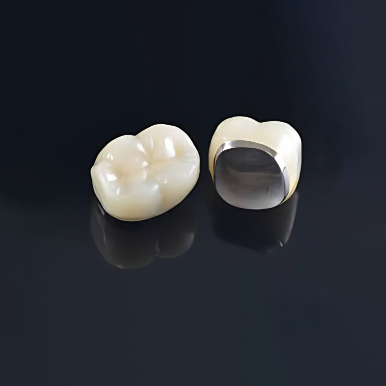 metal ceramic crowns big margin