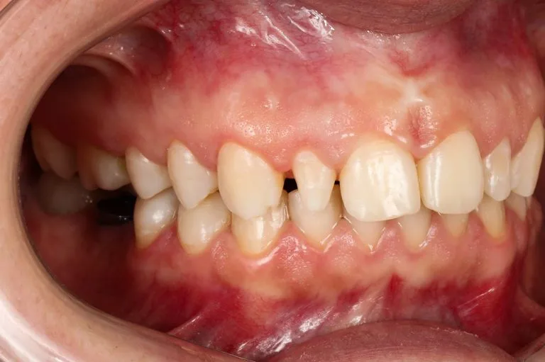 after implantation 3 4 left