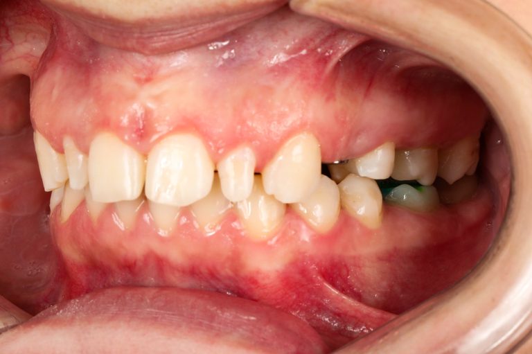 after implantation 3 4 right