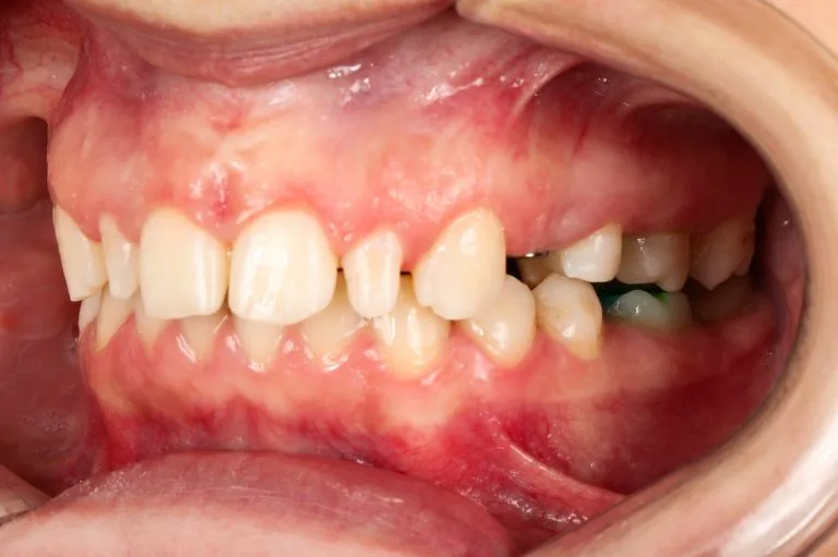after implantation 3 4 right
