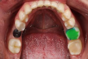 after implantation before preparation lower jaw