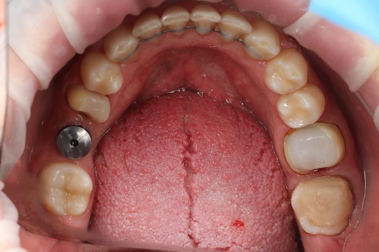 after implantation lower jaw