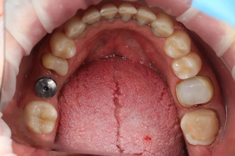 after implantation lower jaw