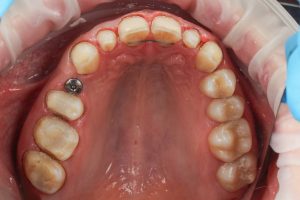 after implantation upper jaw