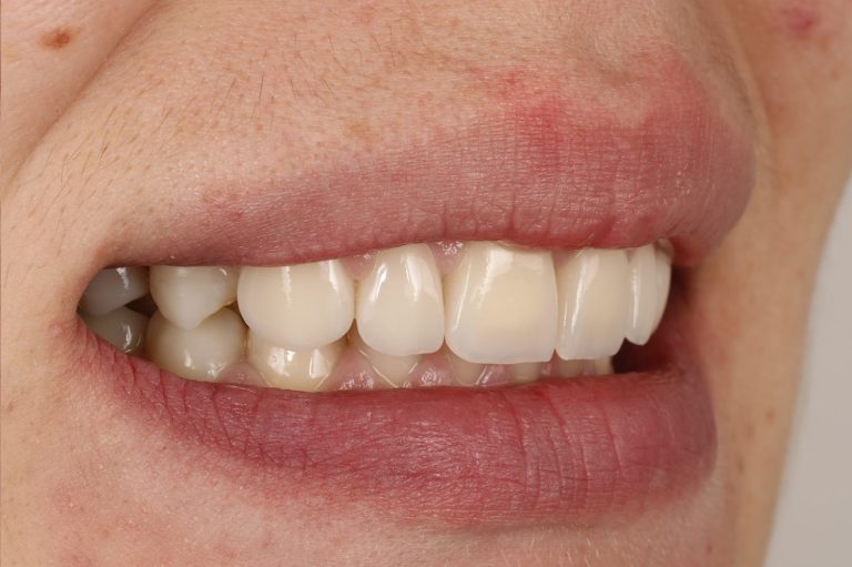 after prosthethics 3 4 left