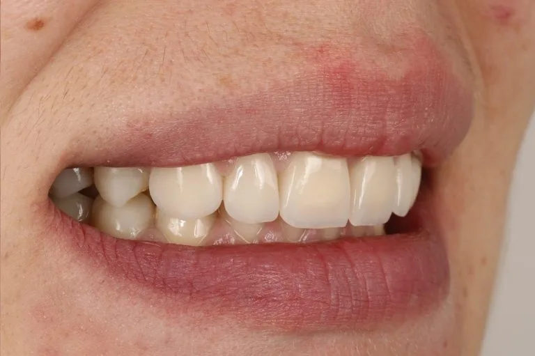 after prosthethics 3 4 left