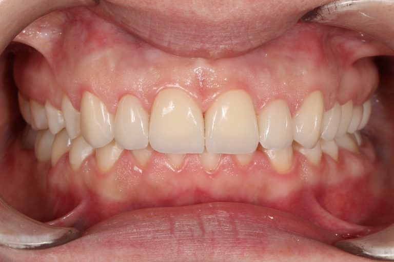 after prosthethics isolated