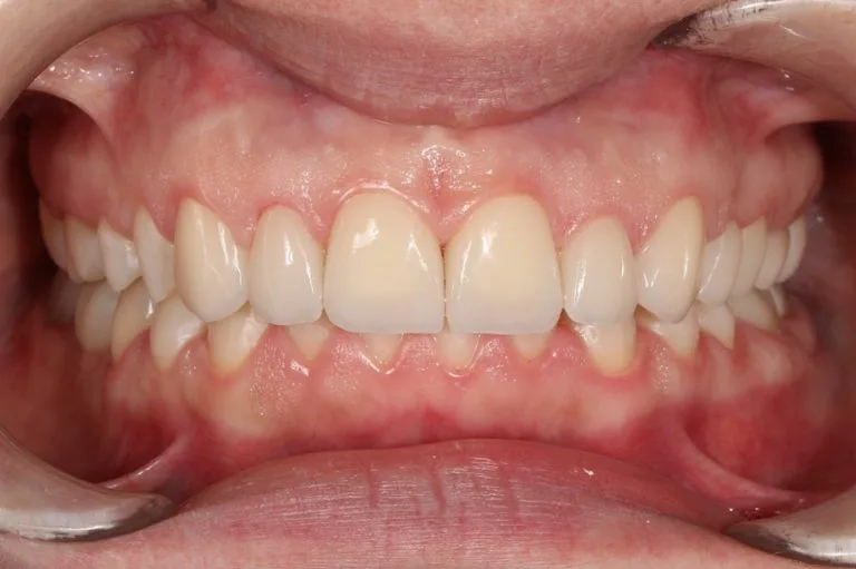 after prosthethics isolated