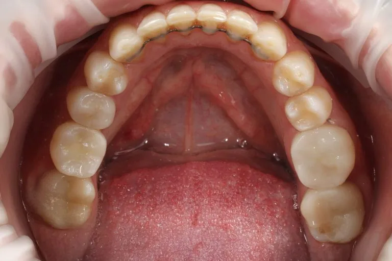 after prosthethics lower jaw above