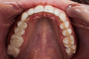 after prosthethics upper jaw below