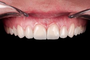 after prosthethics upper jaw front corrected