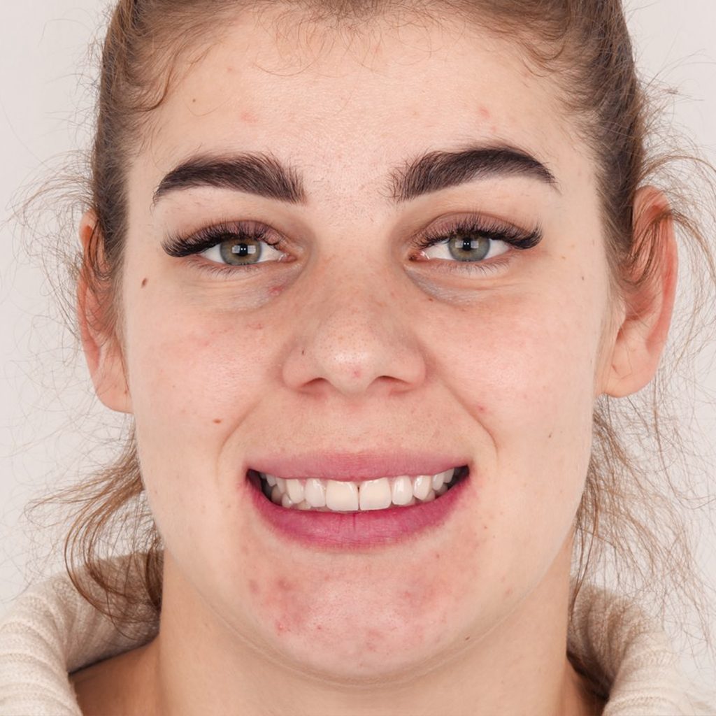 after prosthetics portrait front 1