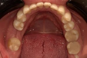 before implantation lower jaw