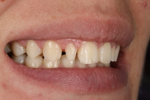 before prosthethics 3 4 left