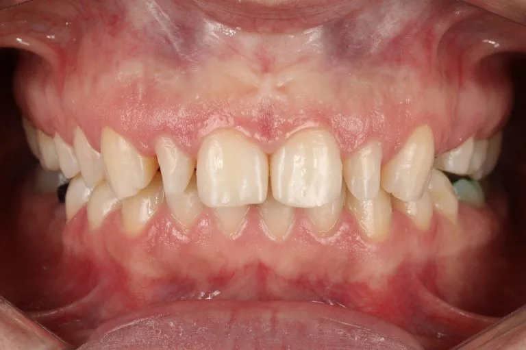 before prosthethics isolated