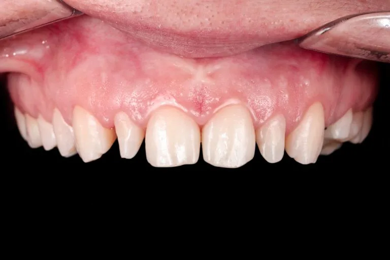 before prosthethics upper jaw front