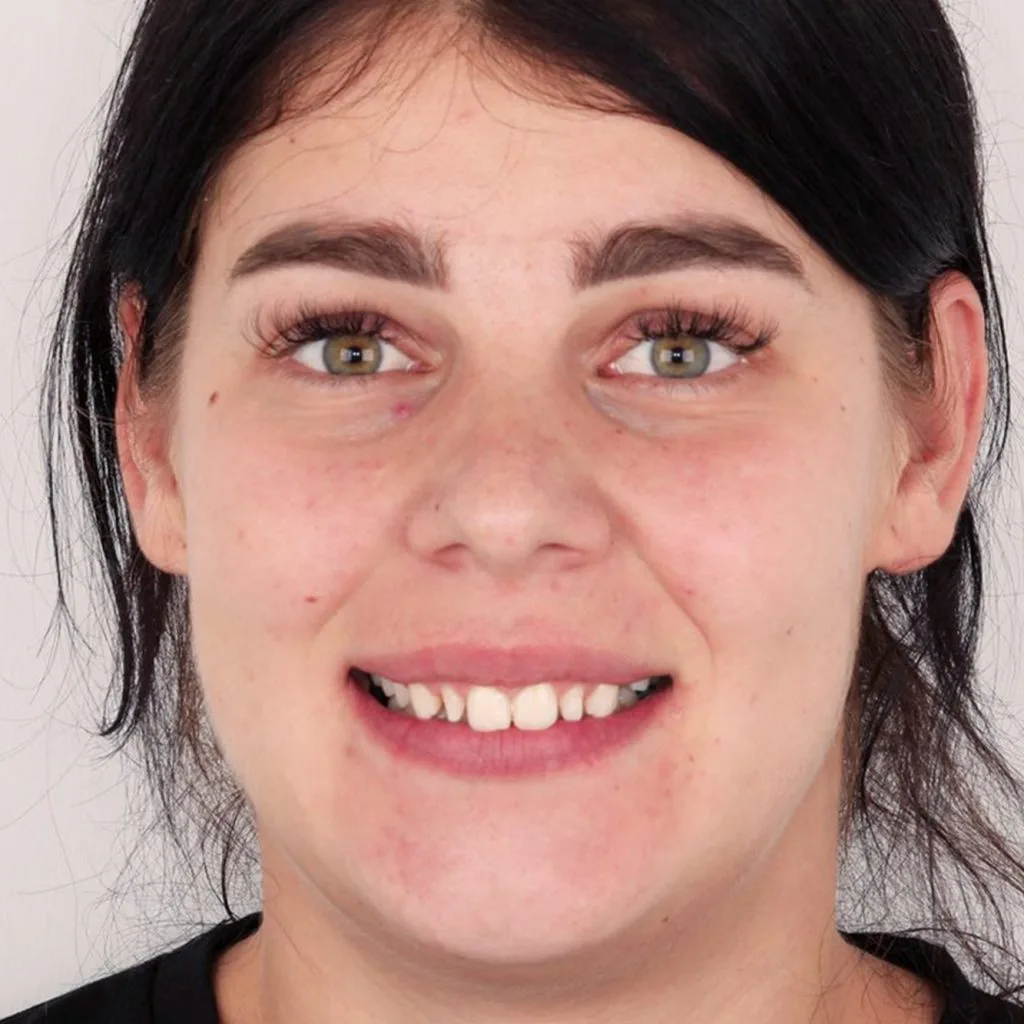 before prosthetics portrait front