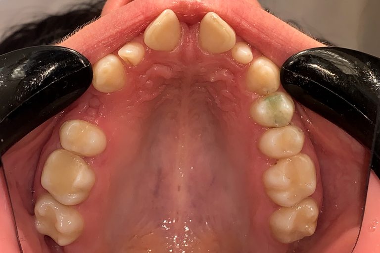 before upper jaw