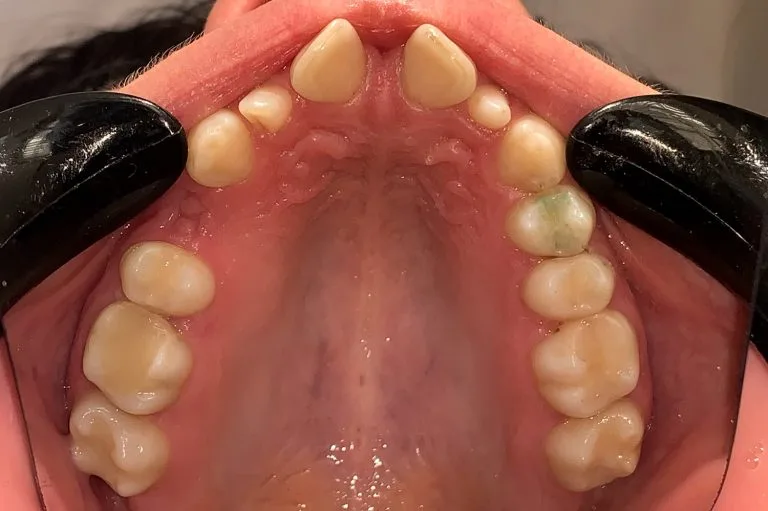 before upper jaw