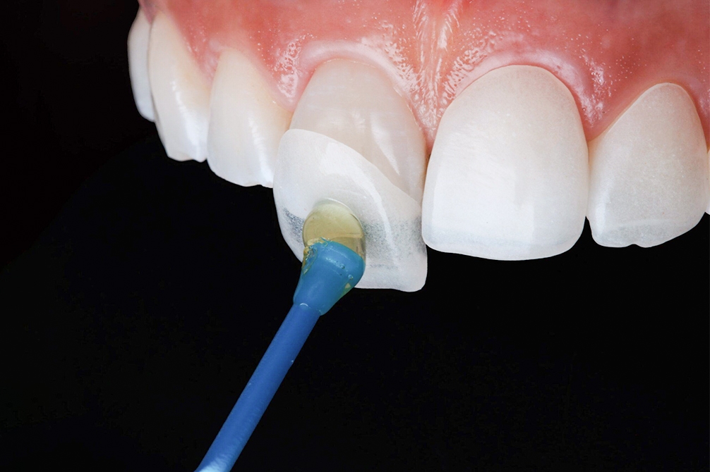 ceramic veneers 2