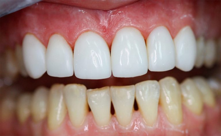 composite veneers 2