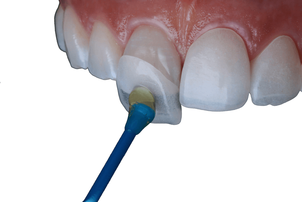 dental veneers